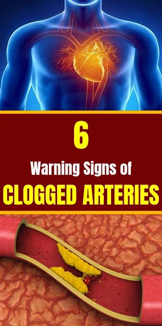 6 Warning Signs of Clogged Arteries