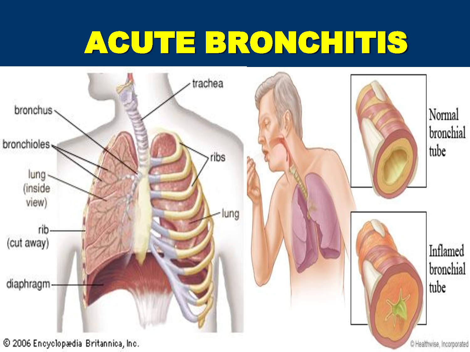 sharp back pain bronchitis