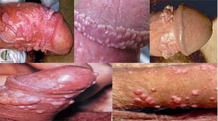 Penyebab Datangnya Virus Hpv