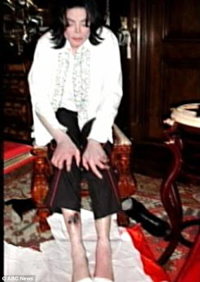 Michael Jackson's Drug-ravaged Legs