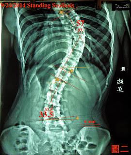 脊椎側彎, 脊椎側彎背架, 脊椎度數, 脊椎側彎矯正, 脊椎側彎治療, schroth運動, schroth脊椎側彎, 德國Schroth, 脊椎側彎矯正運動, 脊椎側彎會怎樣