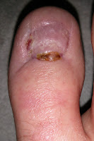 Big Toenail Removal - Right Foot - 12 Weeks & 4 Days