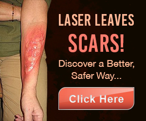 Laser Leaves Scars Discover a better Saver Way