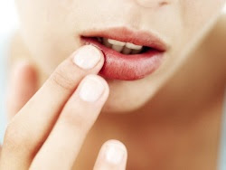 Saiba se é possível prevenir a Herpes labial