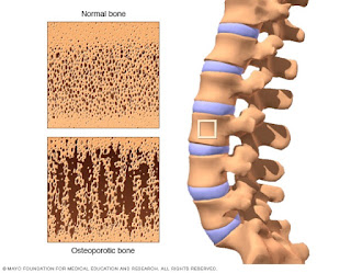 Penyakit Tulang Rapuh, Osteoporosis, Kalsium Penting Untuk Tulang, Elak Tulang rapuh, Pengedar Ostematrix Shaklee, Shaklee Malaysia, Pengedar Vivix Shaklee, Pengedar vivix johor