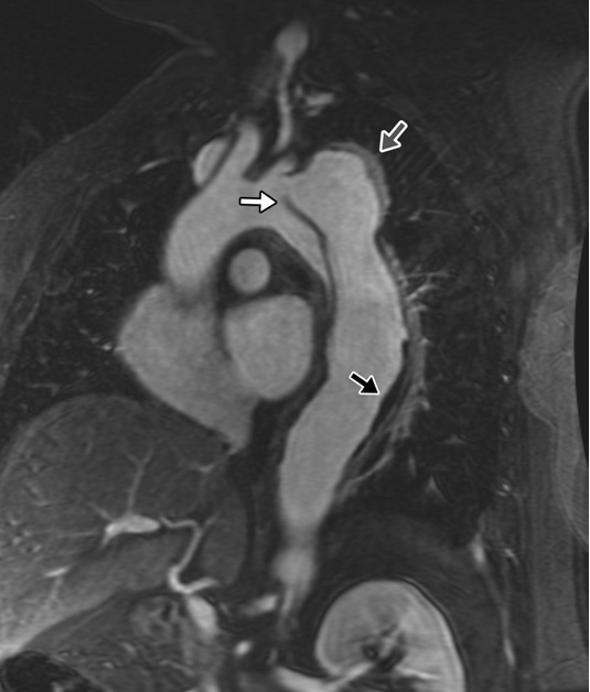 Cardiac MR (Magnetic resonance imaging)