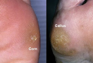 Làm gì đối với corns và calluses?