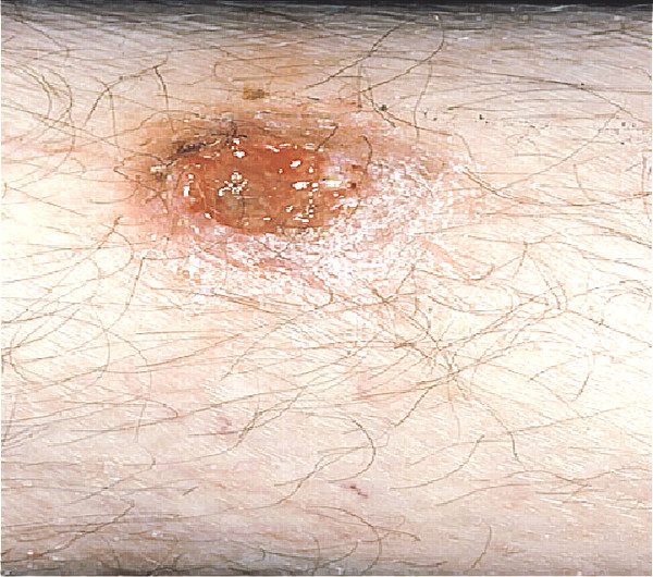 基底細胞癌（basal cell carcinoma），惡性腫瘤相關潰瘍（Ulcers associated with malignancy）