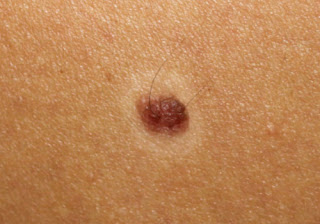 Early Signs of Skin Cancer on Back
