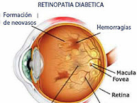 Como Afecta La Diabetes A Los Ojos