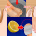 How to Remove an Ingrown Toenail At Home Without Any Surgical Procedure!