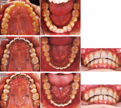 歯列矯正：定期検診その8