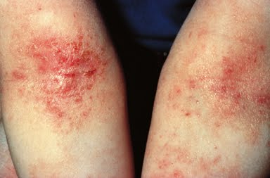 Mybiotechbsy: Noni mampu merawat Eczema
