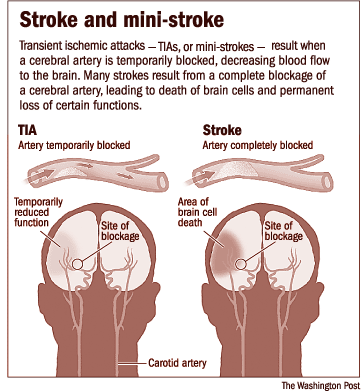 Sometimes symptoms of a stroke