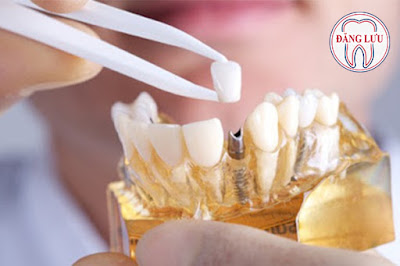 Trồng răng Implant Đăng Lưu ảnh hưởng đến sức khỏe không?