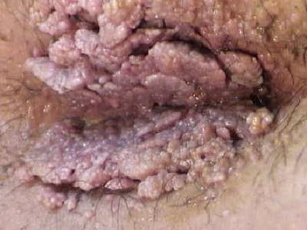 Menghilangkan Hpv