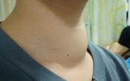 Common Signs and Symptoms of Lymphoma Cancer You Should Know
