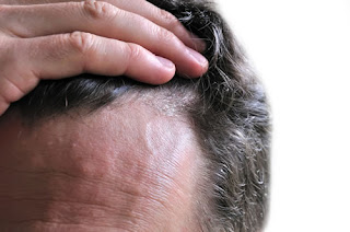 dermatiti seborroiche con alopecia