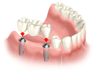 Trụ implant được đặt vào trong xương hàm khi mất răng