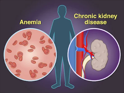 Chronic Kidney Disease-related Anemia
