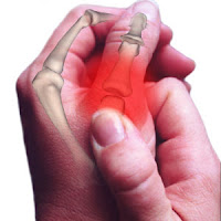 arthritis relief