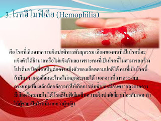   hemophilia คือ, hemophilia คือ pdf, hemophilia พยาธิสภาพ, ฮีโมฟีเลี่ย ป้องกัน, โรคฮีโมฟีเลี่ย การป้องกัน, hemophilia การพยาบาล, โรคตาบอดสี คือ, hemophilia guideline ไทย, hemophilia 8nv