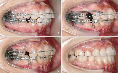 Phương pháp niềng răng khi mất răng 6 chuẩn công nghệ 1