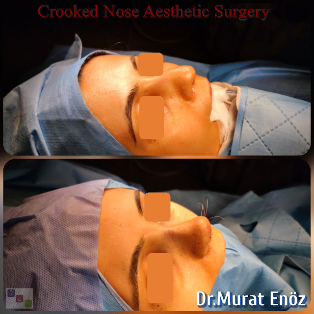 Crooked Nose Job Turkey