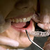Niềng răng bao lâu sẽ nắn chỉnh được hàm móm?