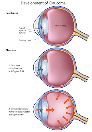 Glaucoma Causes & Development Process