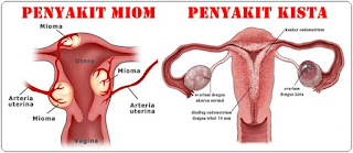 PENGOBATAN ALTERNATIF PENYAKIT MIOM SEMBUH TANPA OPERASI