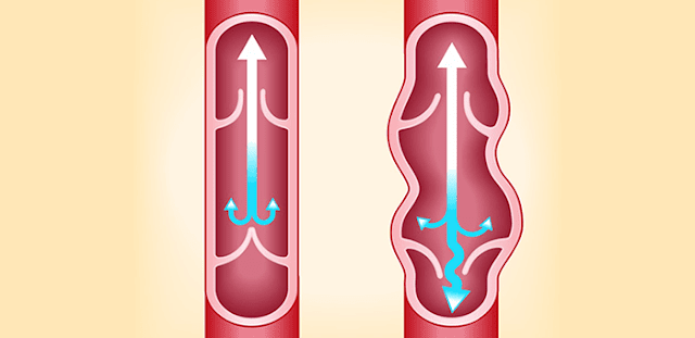 remedios para eliminar las varices