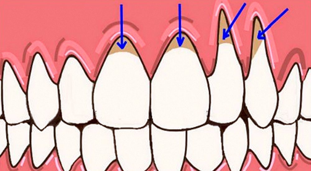 Recesión Gingival