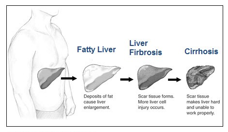 stages-of-liver-damage