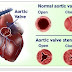 Obat Stenosis Katup Aorta Tradisional