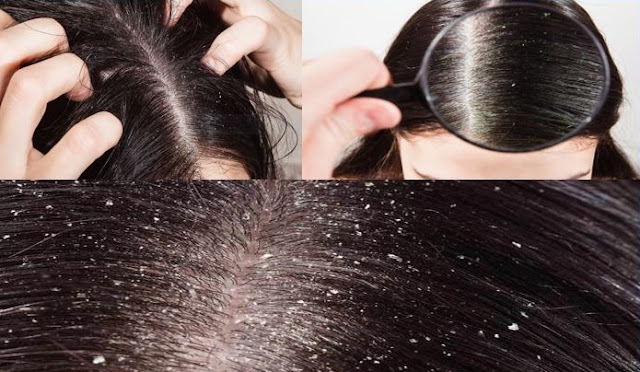 Hair dandruff free in winter