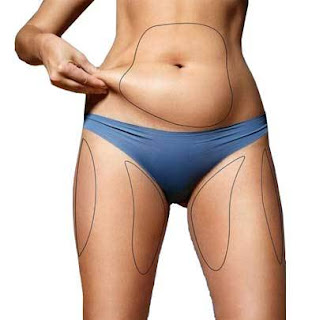 Liposuction in Mumbai