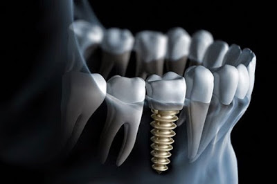 Quy trình cấy ghép implant