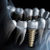 Quy trình cấy ghép implant