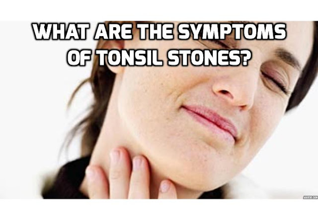 Bad breath is one of the primary symptoms of tonsil stones. Researchers estimate that approximately 75% of people with abnormally unpleasant breath also suffered from tonsil stones. 