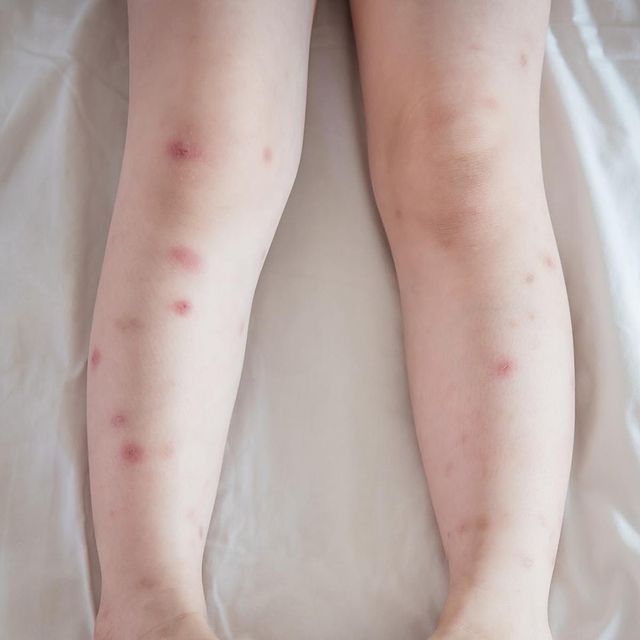 pictures of bed bug bites on legs