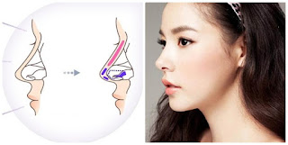 nâng mũi bọc sụn là gì?