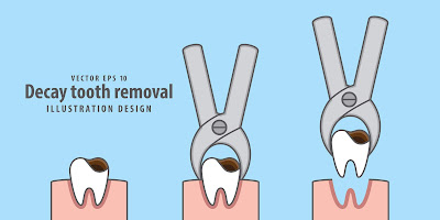 The Top 5 Most Recommended Treatments For Dental Cavities