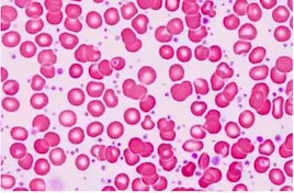 CHRONIC MYELOPROLIFERATIVE NEOPLASMS (MPN)- Essential Thrombocythemia (ET)