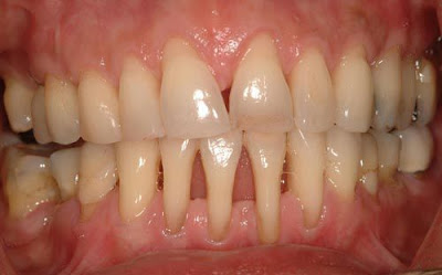 Làm sao để làm trắng răng nhiễm màu nặng?