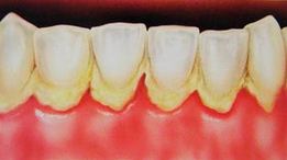 Cara Effektif Menghilangkan Karang Gigi Secara Alami