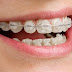 Quy trình niềng răng móm tại nha khoa