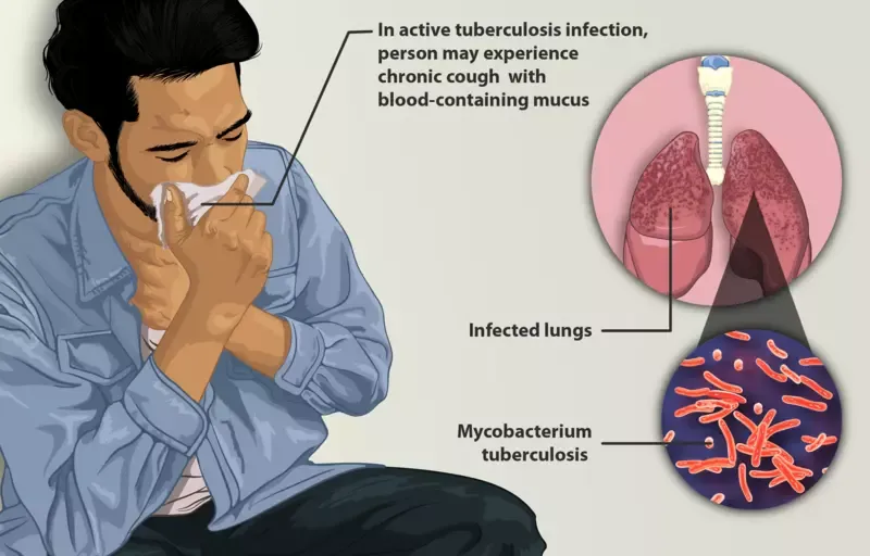 treatment of tuberculosis: depiction of a tuberculosis patient