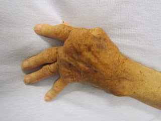 hand with rheumatoid arthritis