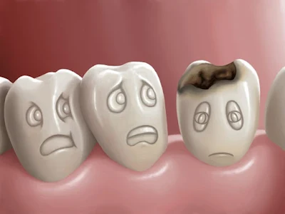 causes-of-dental-cavity